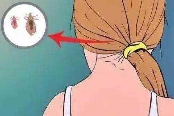 夢見頭上長虱子是什么意思 女人夢到頭上長滿虱子有什么預兆