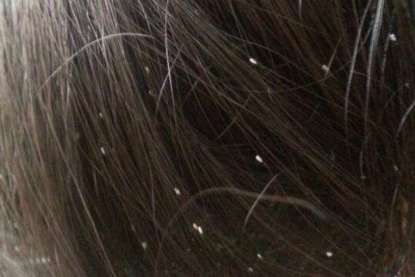 夢見頭上長虱子是什么意思 女人夢到頭上長滿虱子有什么預兆