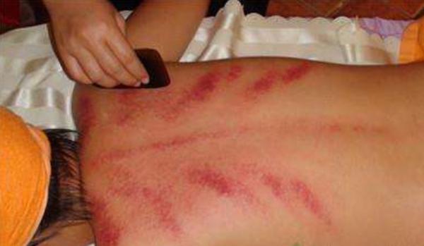 刮痧后多久能運動 刮痧后不能吃什么