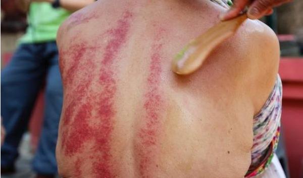 頸椎病刮痧有用嗎 頸椎病刮痧刮哪里