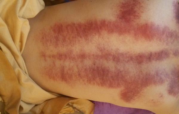 頸椎病刮痧有用嗎 頸椎病刮痧刮哪里