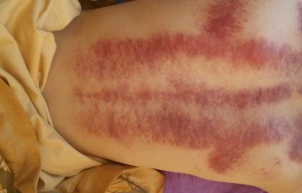 刮痧后可以吹空調嗎 刮痧后多久可以洗澡