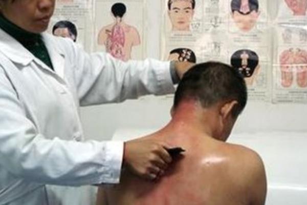 中暑刮痧有用嗎 發燒可以刮痧嗎