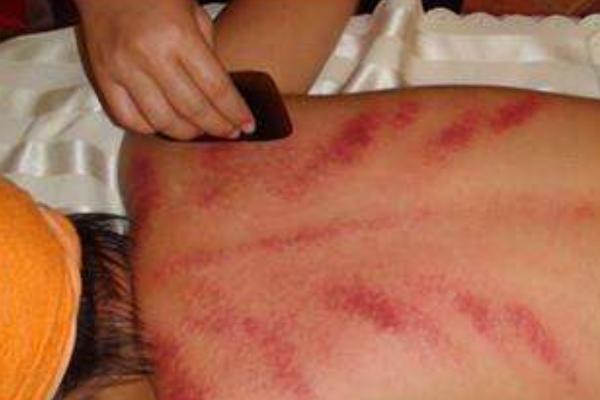 中暑刮痧有用嗎 發(fā)燒可以刮痧嗎