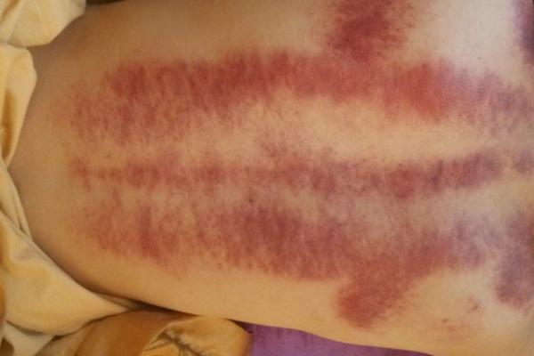 中暑刮痧有用嗎 發(fā)燒可以刮痧嗎