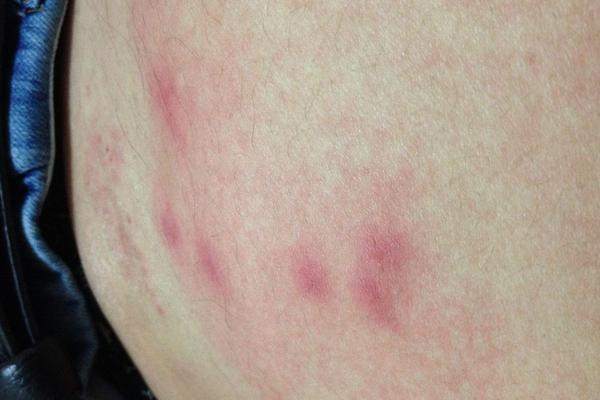 跳蚤為什么只咬一個人 跳蚤和蚊子咬的區別是什么