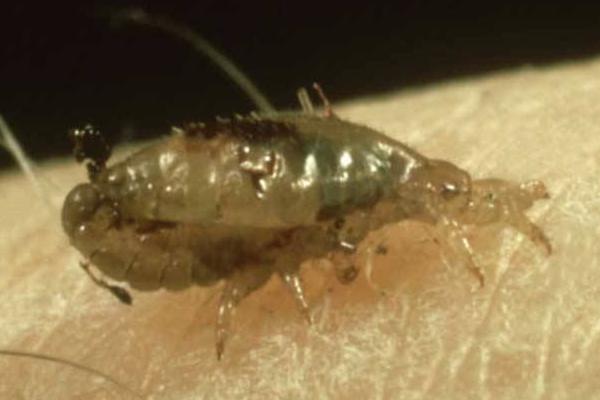 頭上長虱子怎么辦 頭上虱子怎么徹底去除