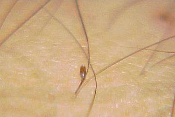 頭上長虱子怎么辦 頭上虱子怎么徹底去除