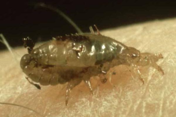 虱子卵怎么徹底去除 虱子卵幾天變成虱子