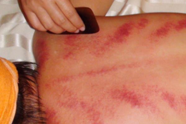 正確的后背刮痧手法圖 刮痧后背部顏色判斷