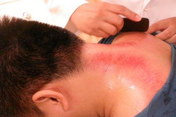 正確的后背刮痧手法圖 刮痧后背部顏色判斷