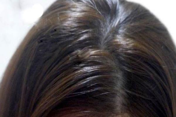 側柏葉洗頭多久洗一次 側柏葉能生發嗎