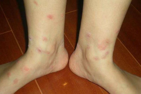 虱子和跳蚤的區別是什么 跳蚤咬的疤痕怎么去除