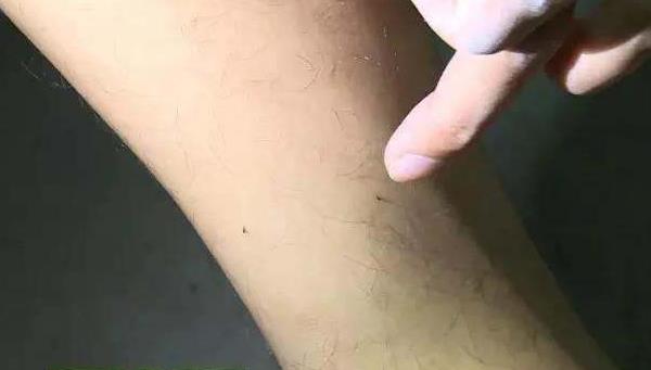 生虱子的原因 頭上為什么會長虱子